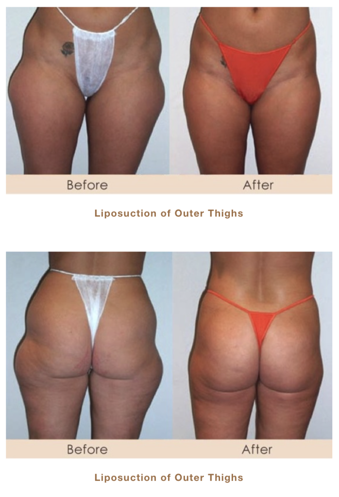 liposuction of outer thighs
